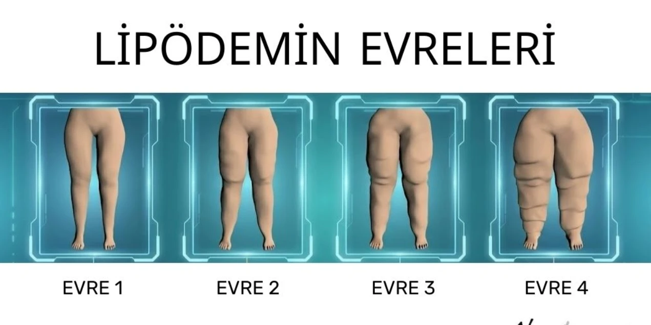 KİLO VEREMİYORSANIZ SUÇLU İRADENİZ DEĞİL, LİPÖDEM OLABİLİR